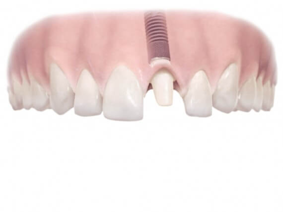 Zahnimplantaten - Einzelnen Zahnes 03