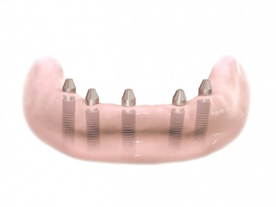 Zahnimplantaten - Kiefer Festsitzender Zahnersatz 01